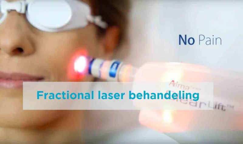 Fractional laser behandeling