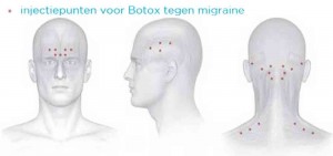 botox-migraine-behandeling