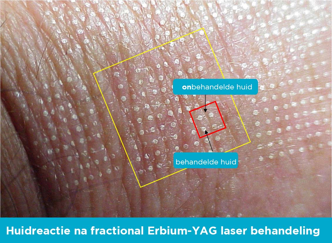 Inloggegevens delen rivier De Fractional laser voor een huidverjongend resultaat