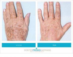behandeling pigment handen voor na