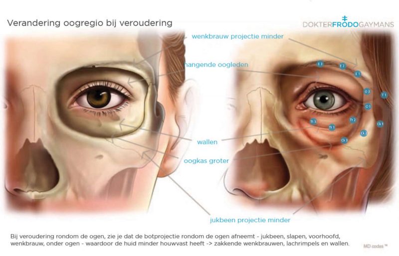 C-ooglift-behandeling-volumeverlies ogen