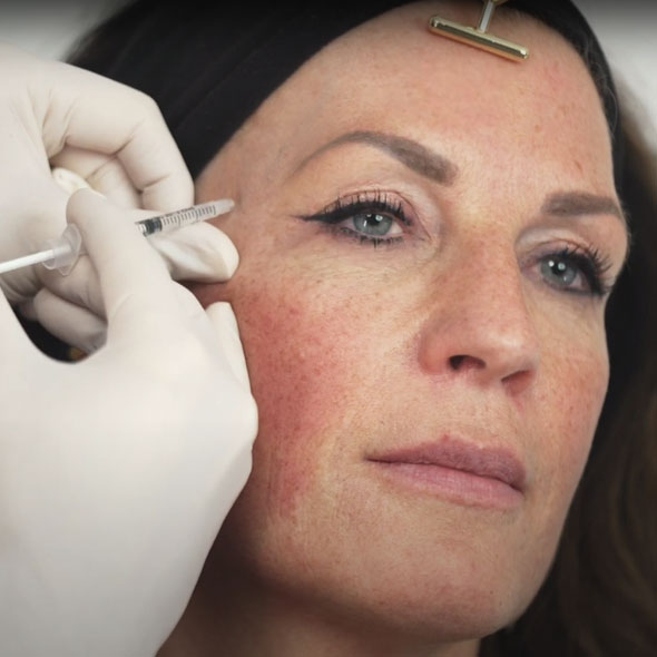 Botox behandeling voor halfzijdige gezichtsverlamming
