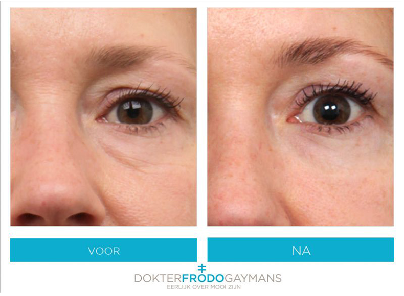 Before and after under-eye treatment