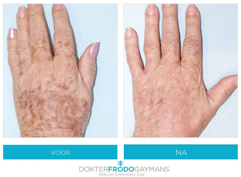 Behandeling pigment handen voor na