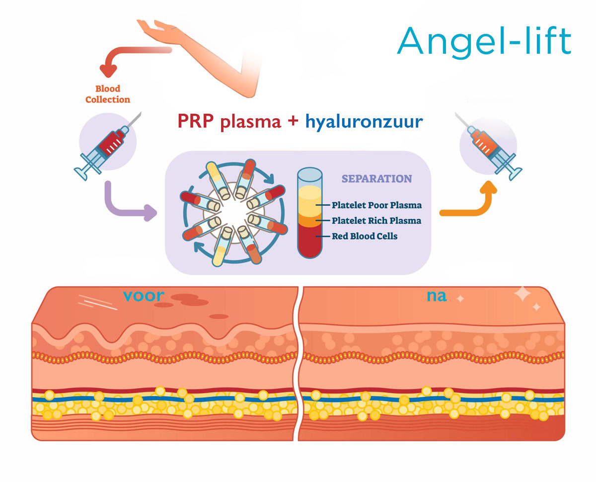 PRP-plasma-Angel-lift-Platelet-Rich-Plasma