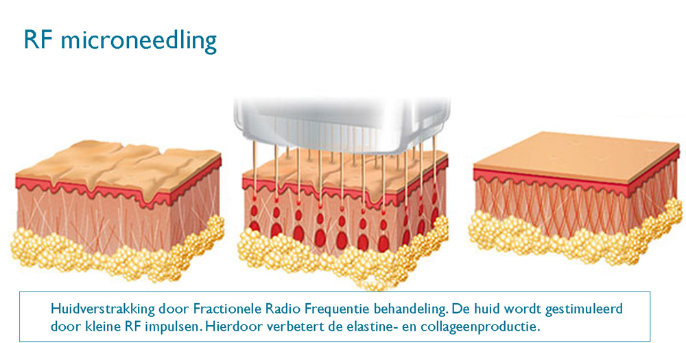 rf-microneedling-huidverstrakking-dokter-frodo